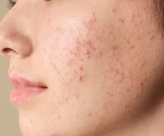 Acne Control